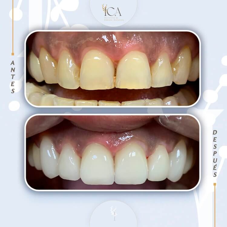 Antes y después del tratamiento con carillas en Tenrife, en ICA.