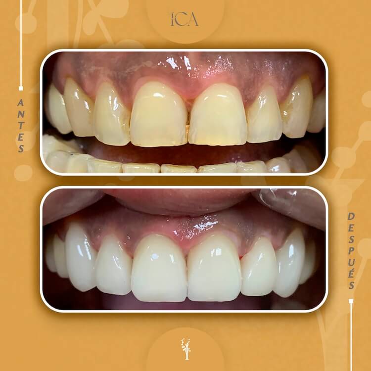 Antes y después de un tratamiento con carillas dentales en ICA, Canarias.