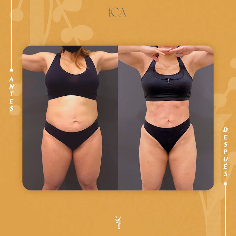 Moldea tu cuerpo en ICA, Tenerife, con sus tratamientos de iposucción.