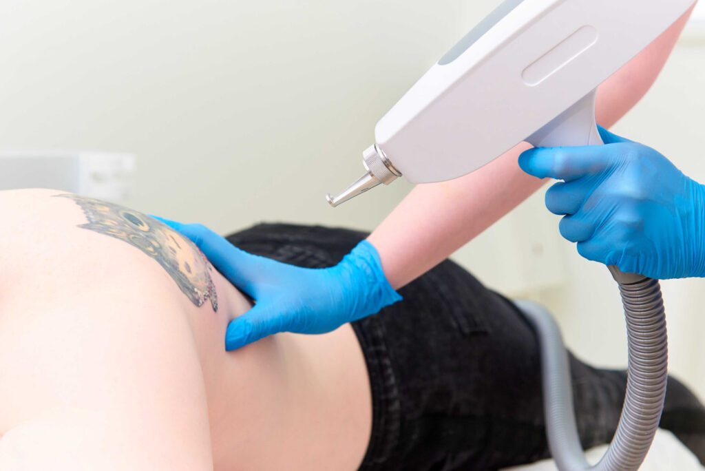 eliminar tatuajes en Canarias