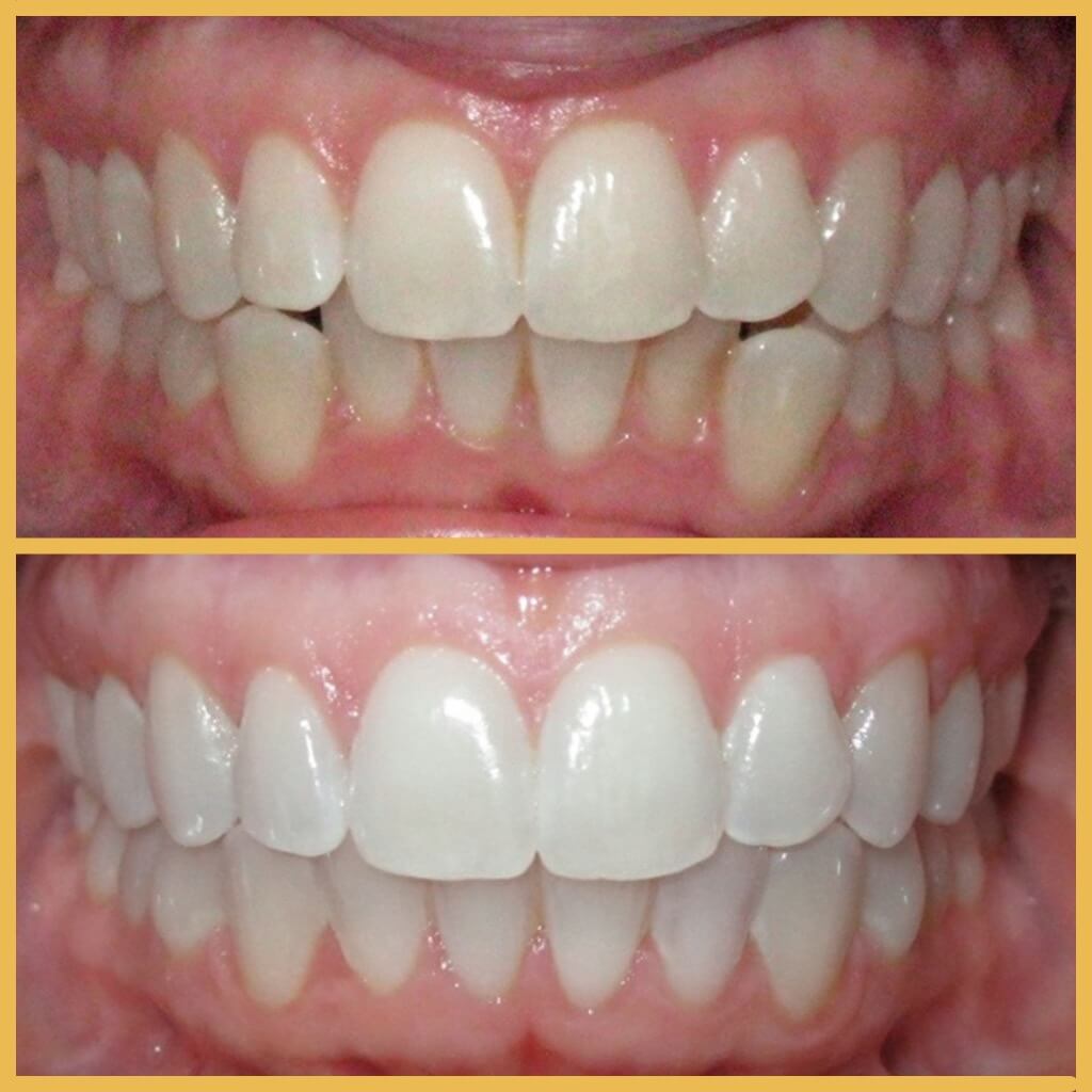 Antes y depués de nuestro tratamiento dental- ICA, Tenerife