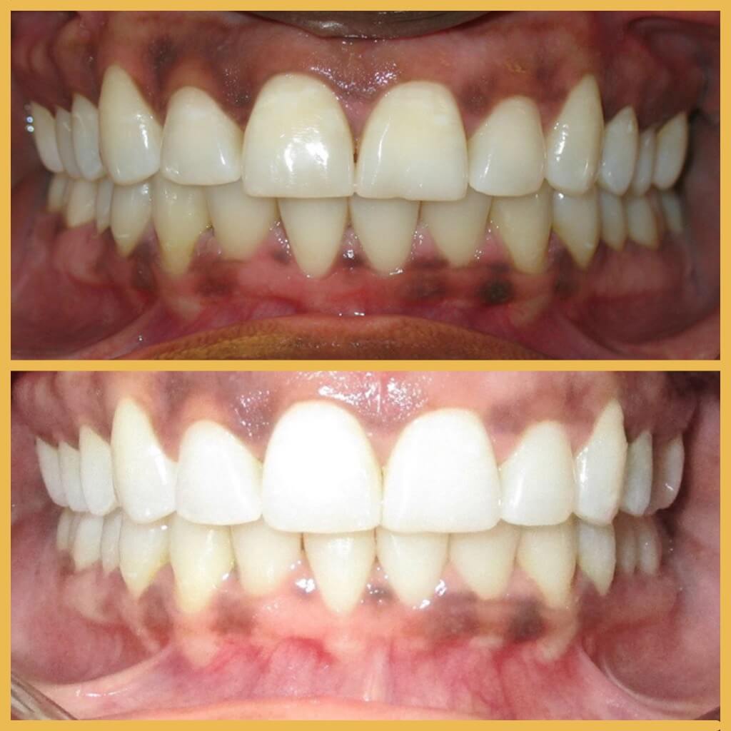 Antes y después tratamiento dental en el Instituto de Cirugía Avanzada en Tenerife