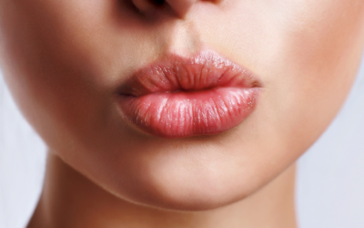 ¿Cuánto dura el Ácido Hialurónico en los labios?