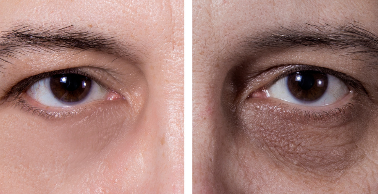 cambia tu expresión eliminando las ojeras hundidas con el tratamiento facial con ácido hialurónico del insituto de cirugía estética de Canarias y Tenerife