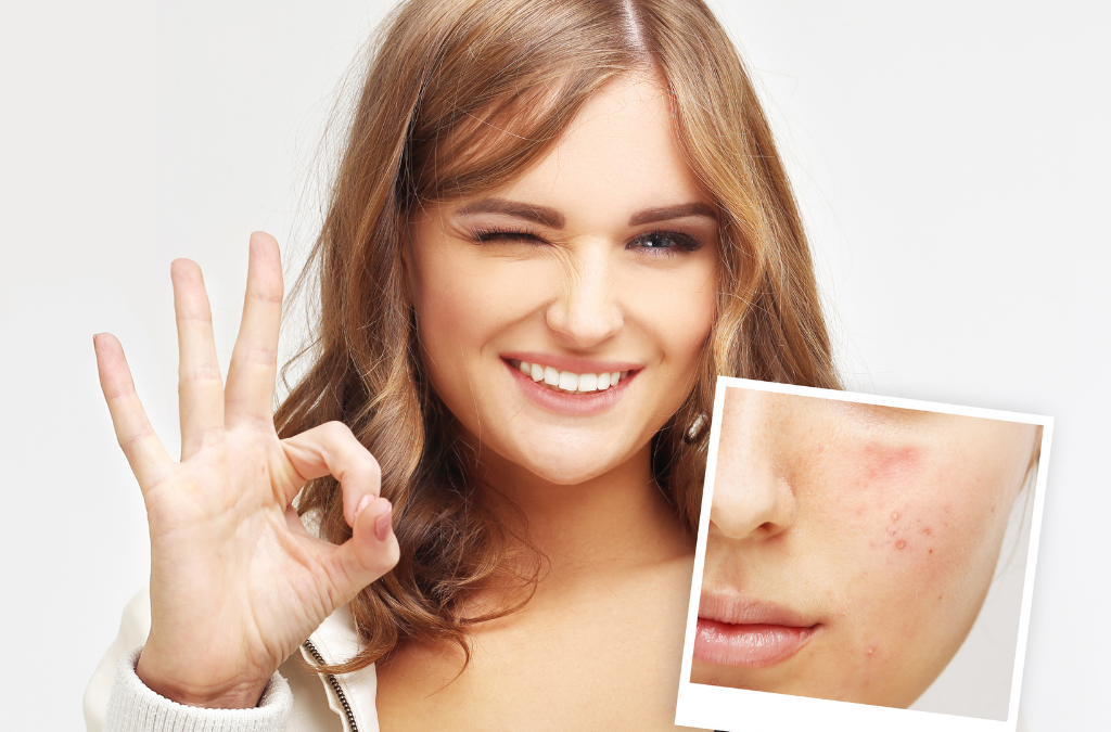 ¿Cuál es el mejor tratamiento para quitar manchas de acné de la cara?