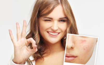 ¿Cuál es el mejor tratamiento para quitar manchas de acné de la cara?