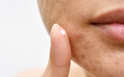 El espectacular resultado del láser para cicatrices del acné