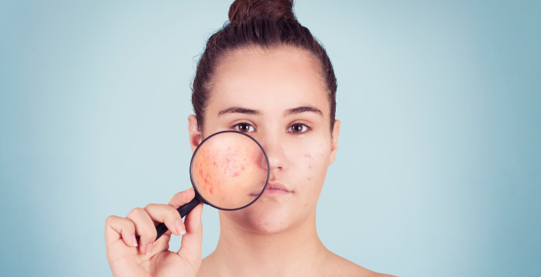 La mayoría de tratamientos con láser para eliminar la cicatrices del acné solo requieren de un máximo de 4 sesiones