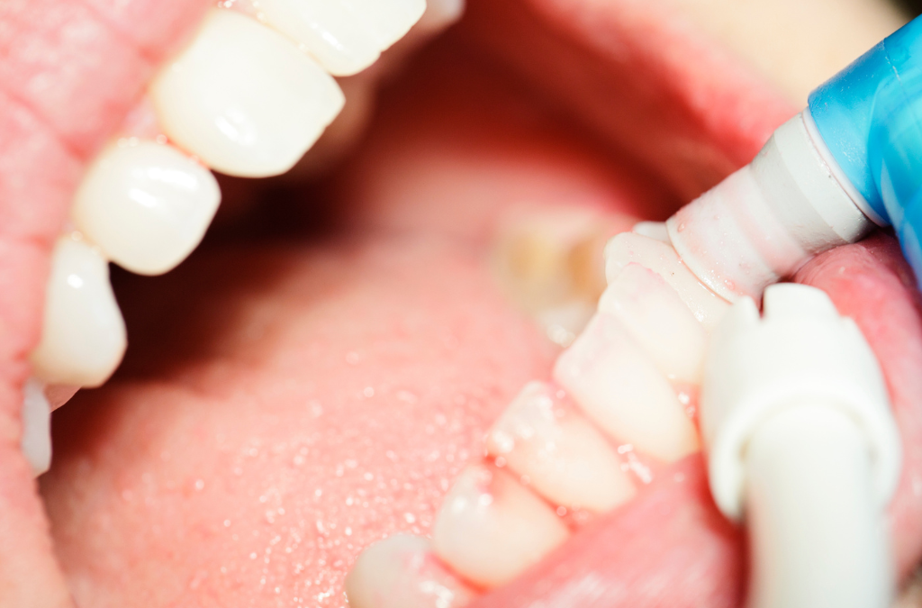 Resolvemos tus dudas: ¿La limpieza dental daña los dientes?
