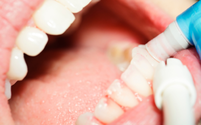 Resolvemos tus dudas: ¿La limpieza dental daña los dientes?