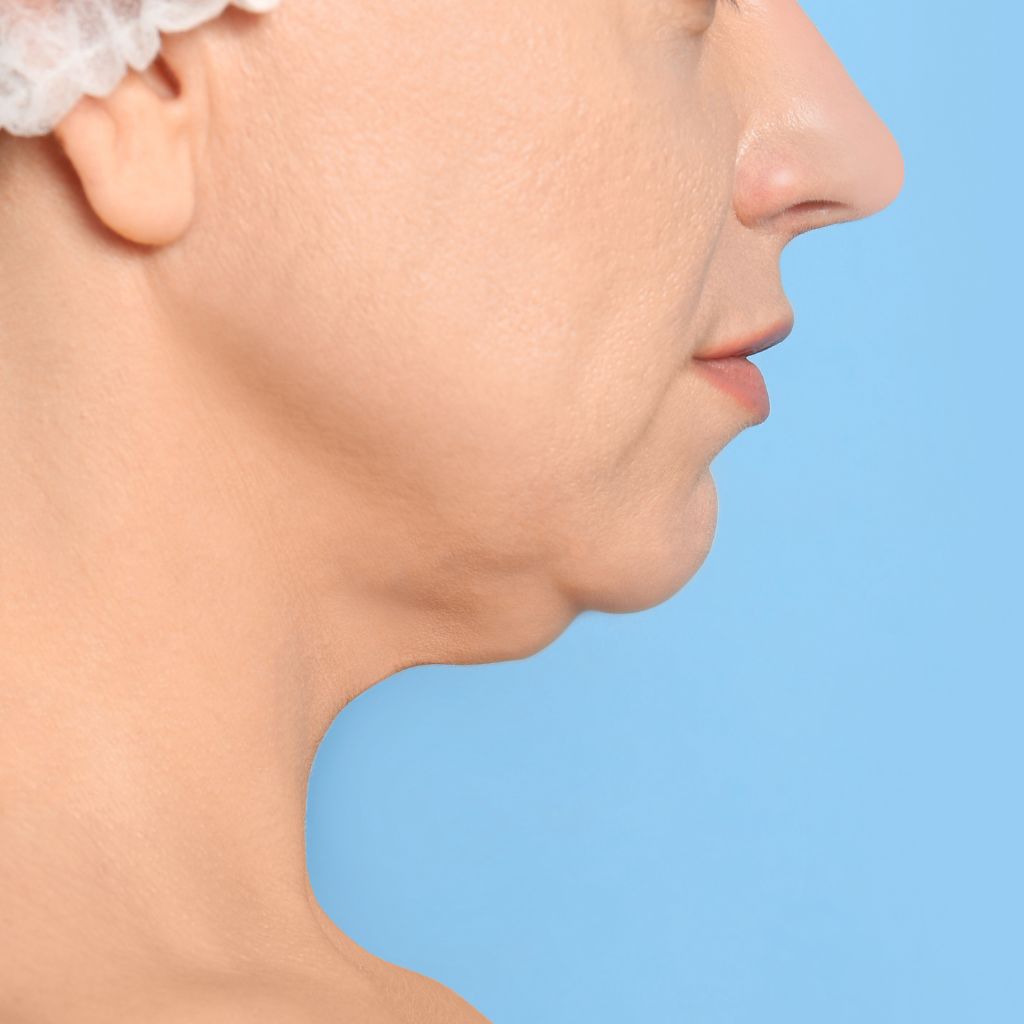Todo lo que quieres saber sobre la liposucción de la papada | ICA