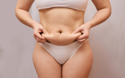 Tratamiento coolsculpting: la liposucción sin cirugía