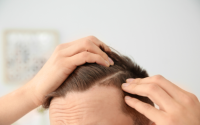 Terapia fotodinámica con cascos LED contra la caída del cabello