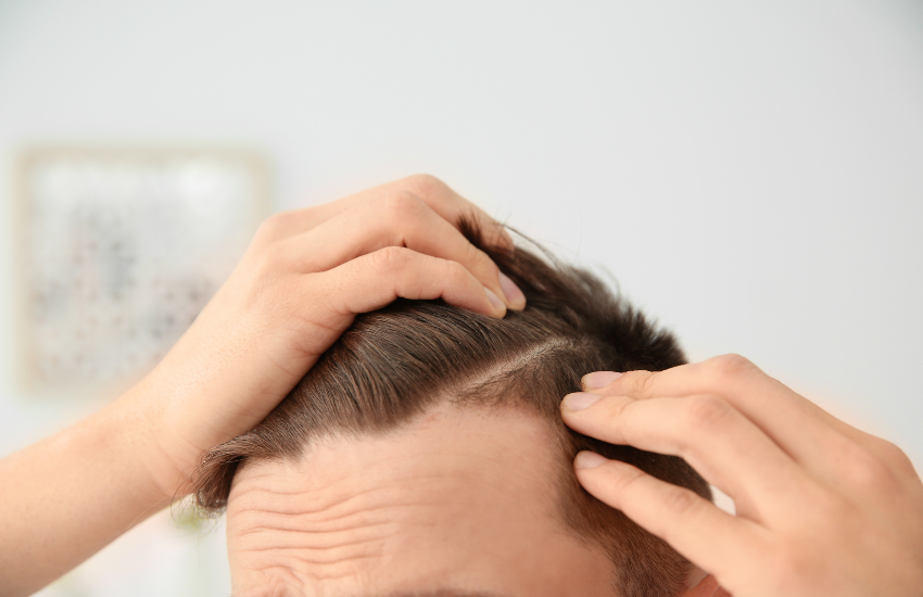 Terapia fotodinámica con cascos LED contra la caída del cabello