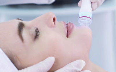 Microneedling para la mejora de tu piel