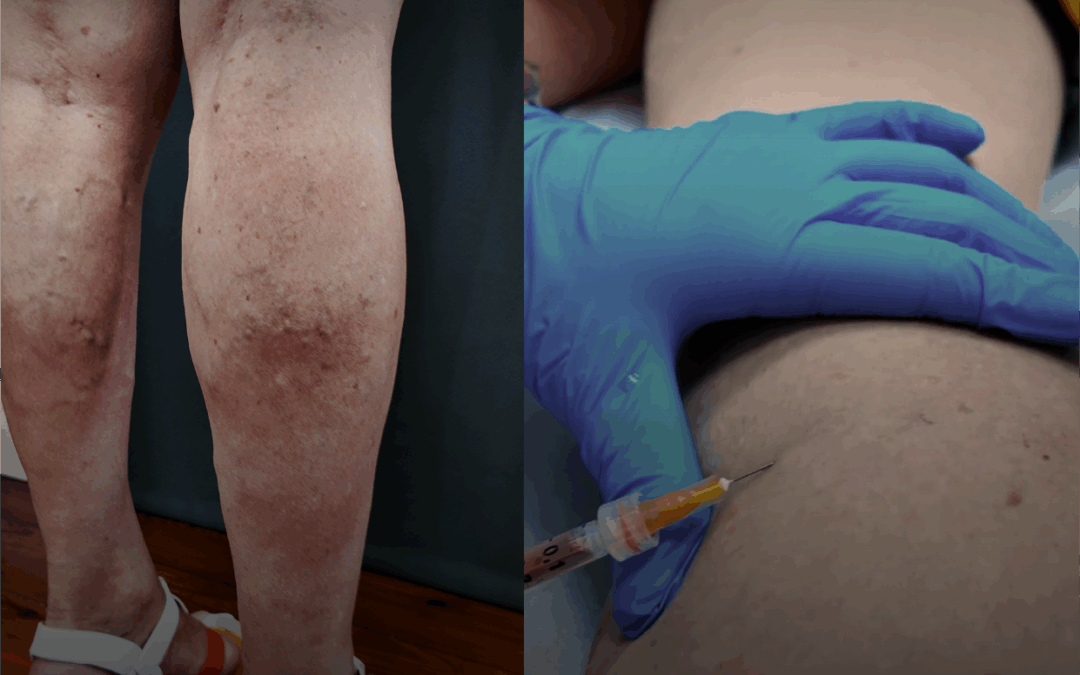 ¿Tus piernas muestran varices? No tienes que resignarte