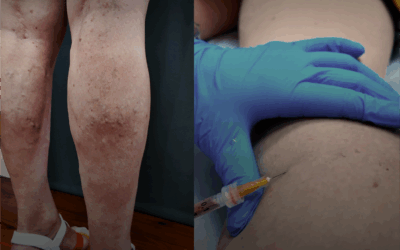 ¿Tus piernas muestran varices? No tienes que resignarte