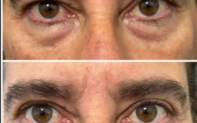 Blefaroplastia en Canarias: rejuvenece tu mirada con resultados naturales