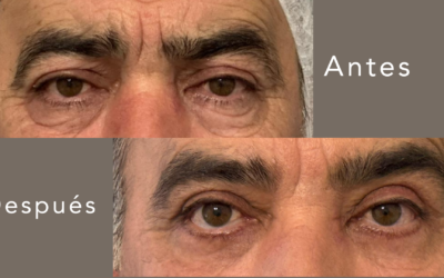 Bolsas vs. ojeras: no es lo mismo