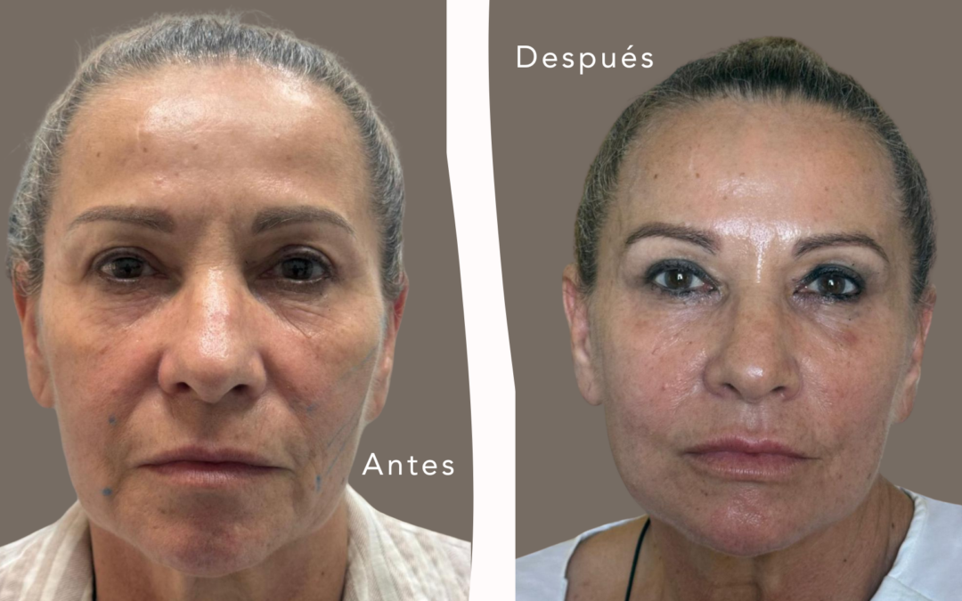 Rejuvenecimiento sin cirugía: qué opciones existen realmente